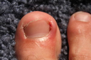 Example of an Ingrown Toenail