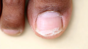 Toenail Damage