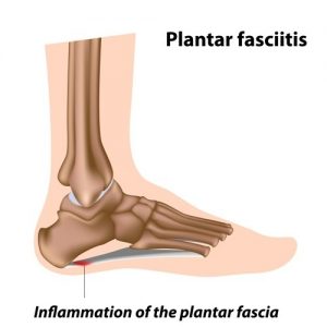 Inflammation of the plantar fascia