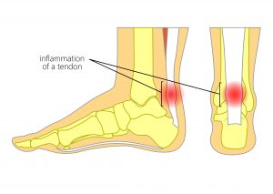 foot pain achilles tendon