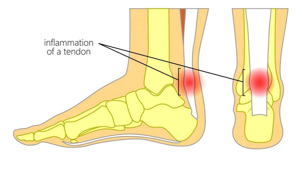 Achilles Tendon Pain Without Injury Ar