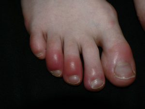 Chilblains toes