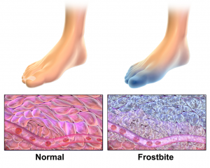 frostbite foot