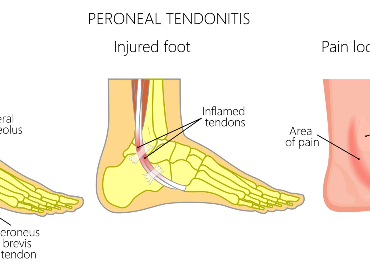 plantar tendonitis