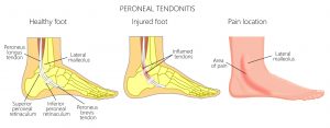 peroneal tendon tear