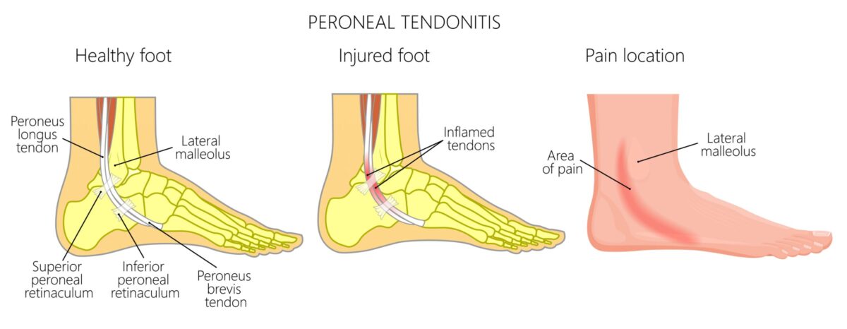 Peroneal Tendonitis | Causes Symptoms and Treatment Options