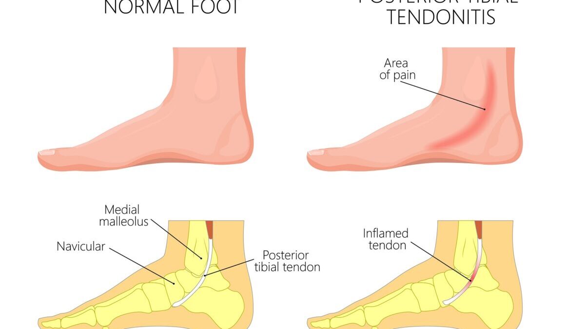 inner ankle heel pain