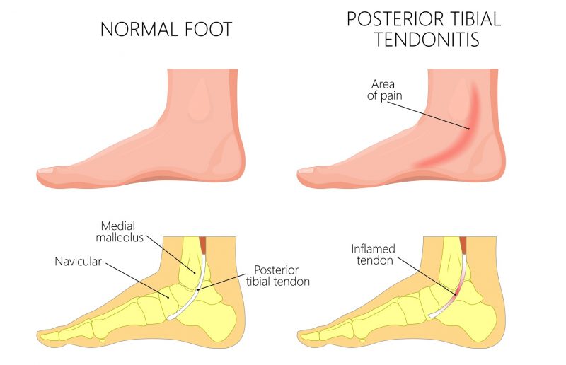 Inner sole of foot on sale pain