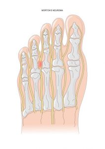 Location of a Morton's Neuroma