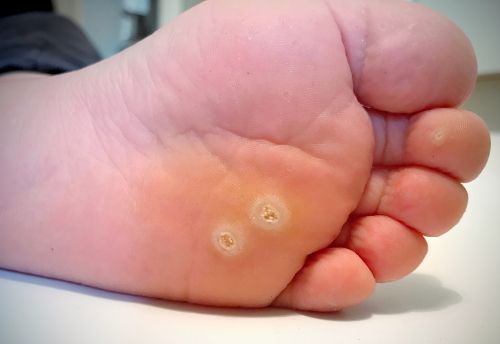 Big toe recently apmutated, now finding this wart at the bottom of