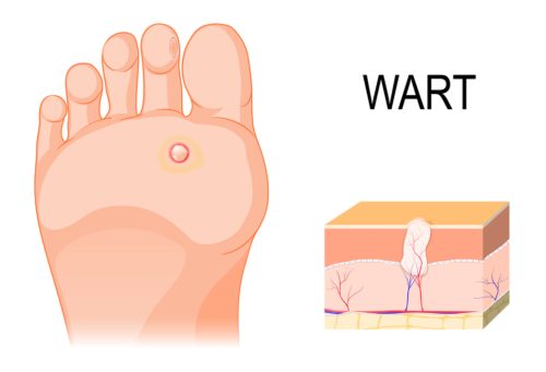 Wart