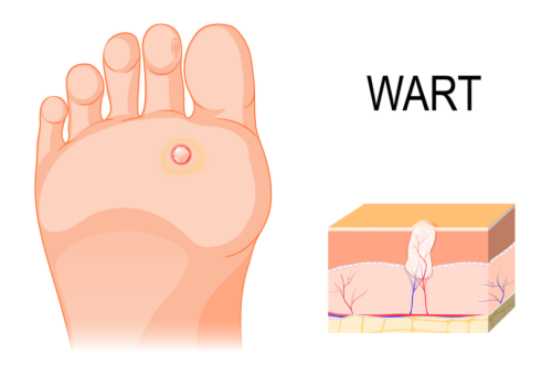 Wart