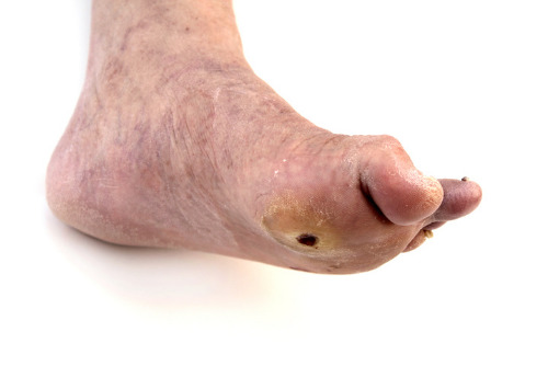 Diabetes foot wound