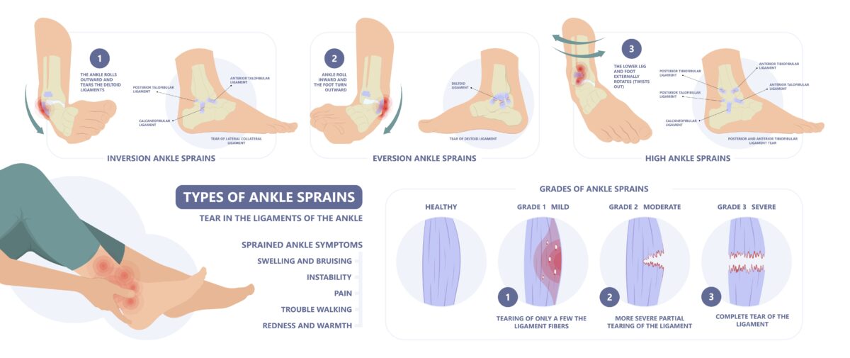 Infograph of types of ankle sprains
