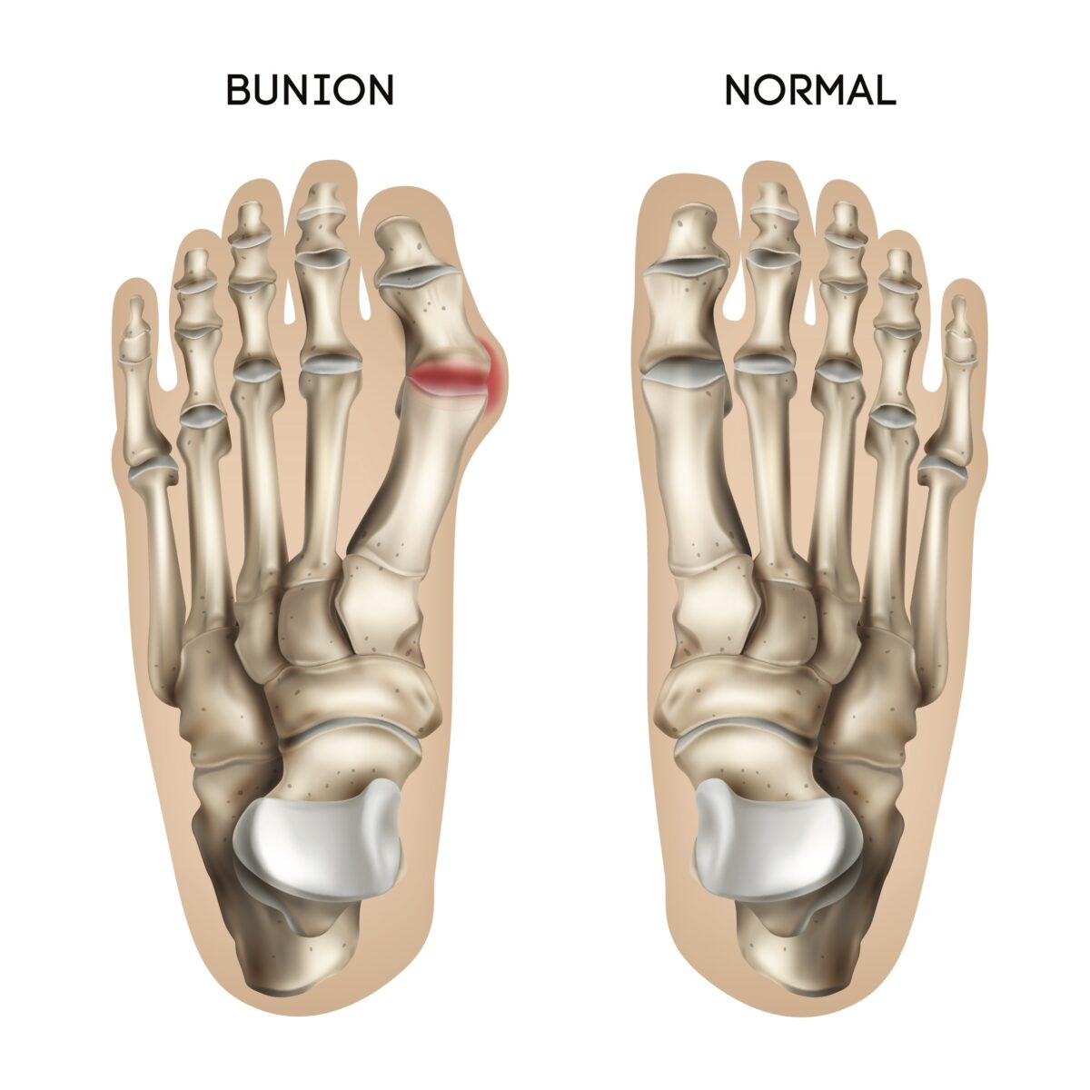 Foot with a bunion and a normal foot