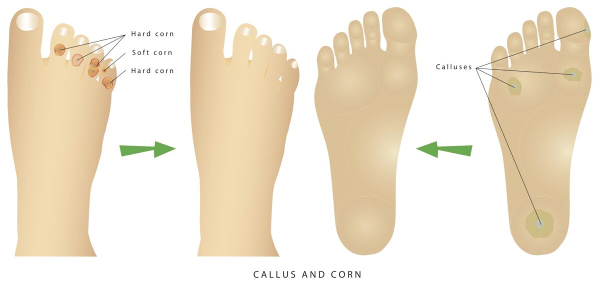 Calluses vs Corns on a foot