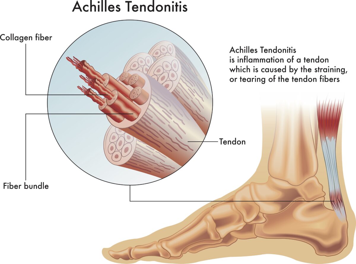 Image of achilles tendonitis and what it looks like