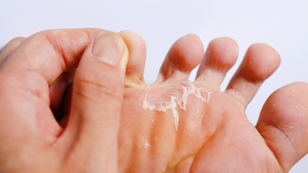 Athlete's Foot: Causes, Symptoms, Types, Risk Factors, Diagnosis,  Treatment, Prevention and Complications