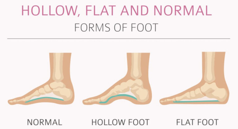 About Flat Feet | Caruso Foot & Ankle