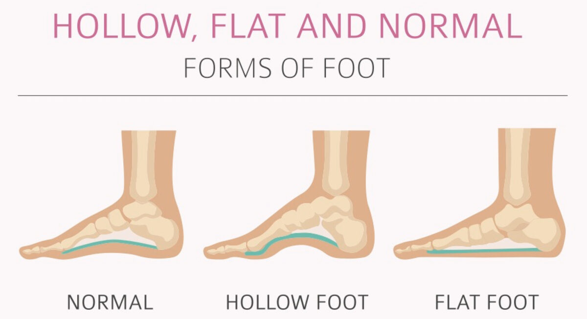 Normal foot, hollow foot, and flat foot images
