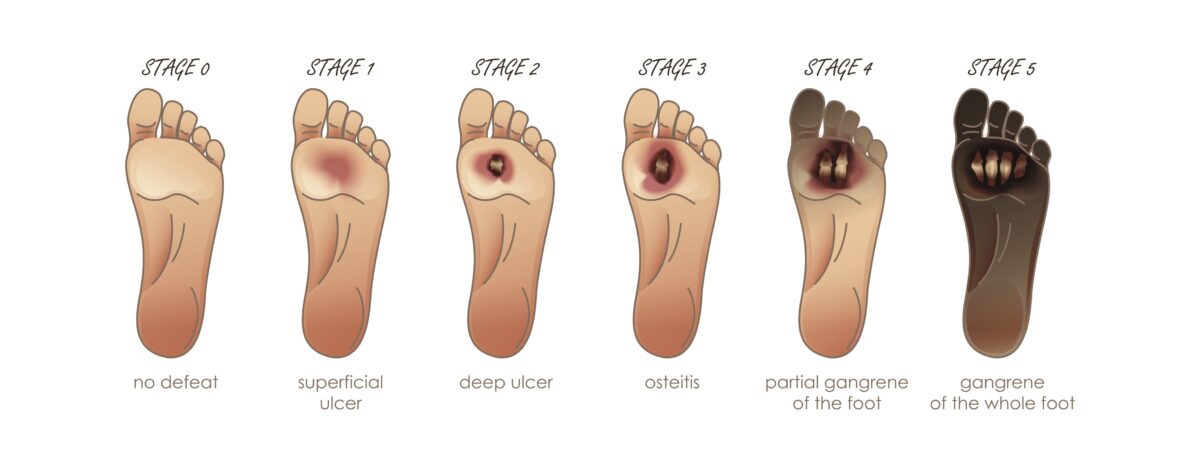 Stages 0-5 of a foot ulcer