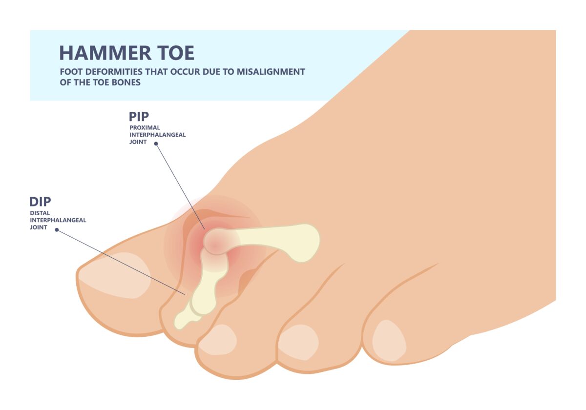 Hammertoe image with descriptions