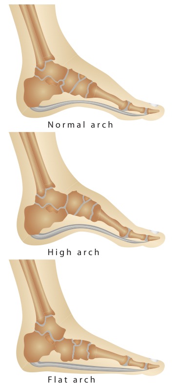 Normal arch vs high arch vs. flat arch