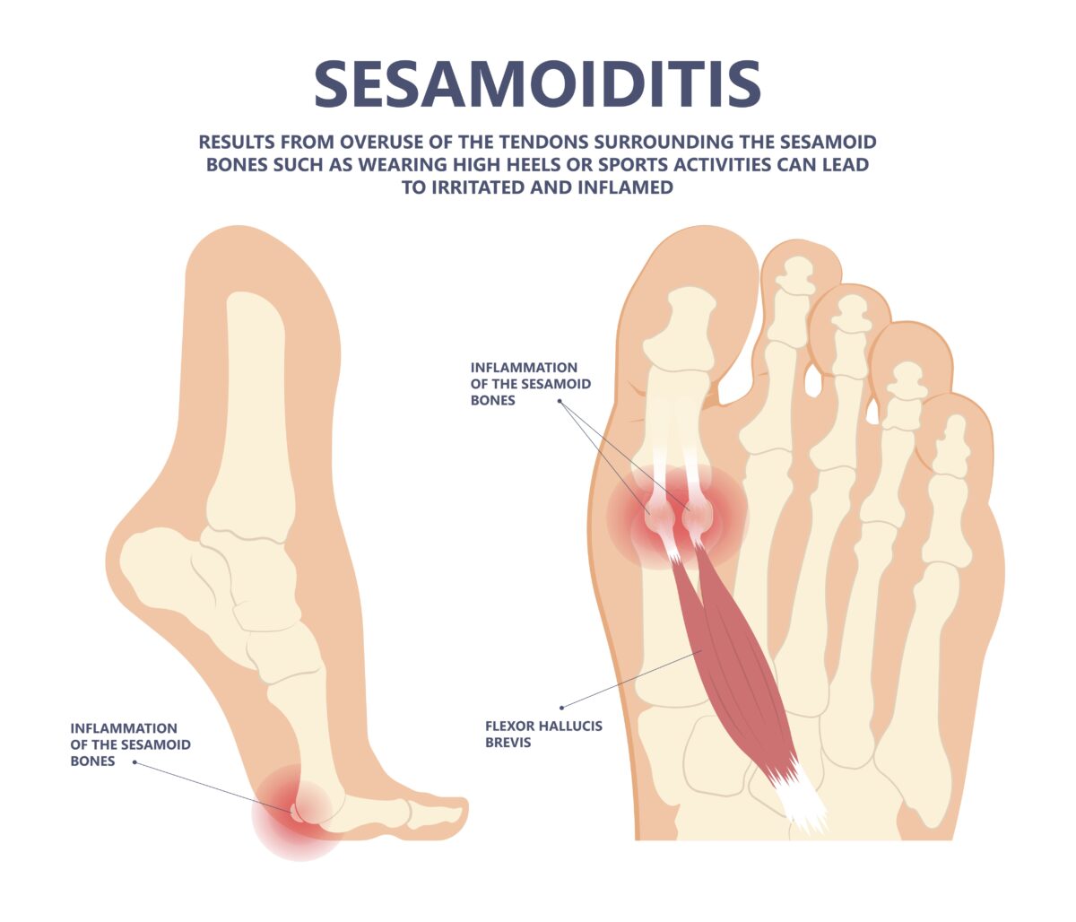 Sesamoiditis foot store