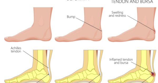 About Haglund's Deformity - Caruso Foot & Ankle