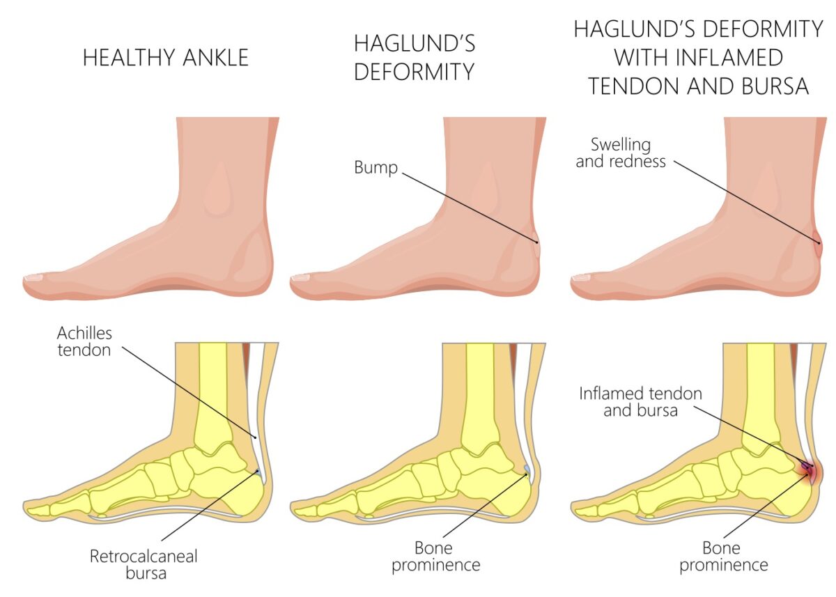 Haglunds Deformity with a description