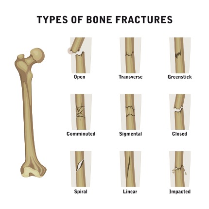 Types of bone fractures