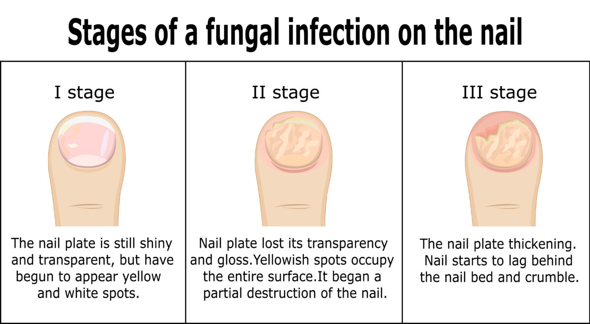 Nail Fungus three images in three stages